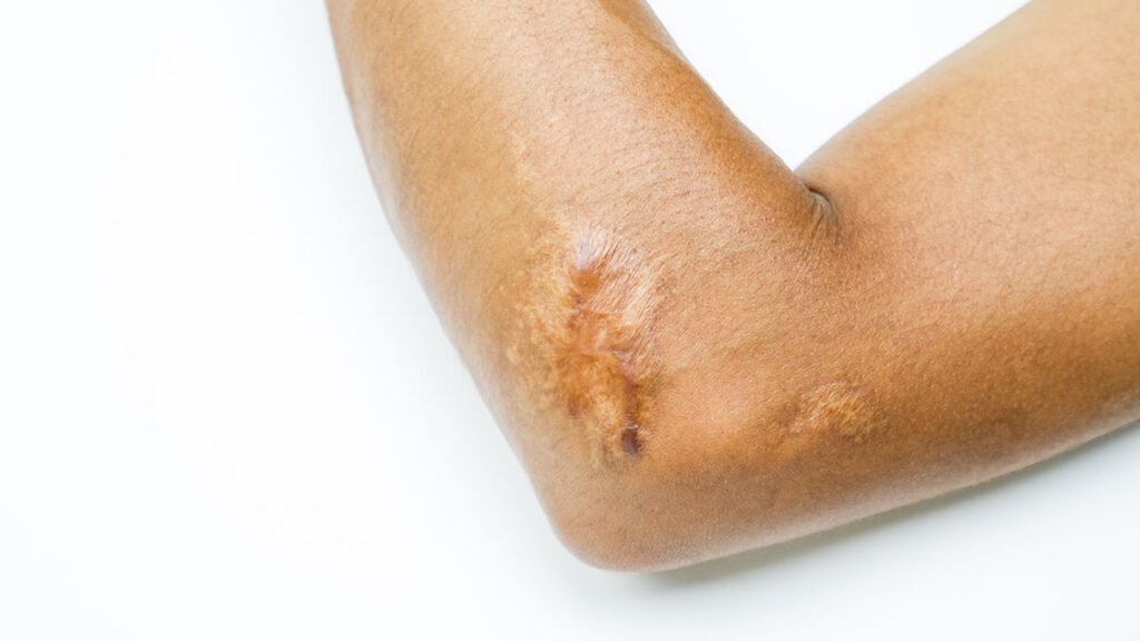Améliorer la texture de la peau grâce au traitement des cicatrices par ondes de choc