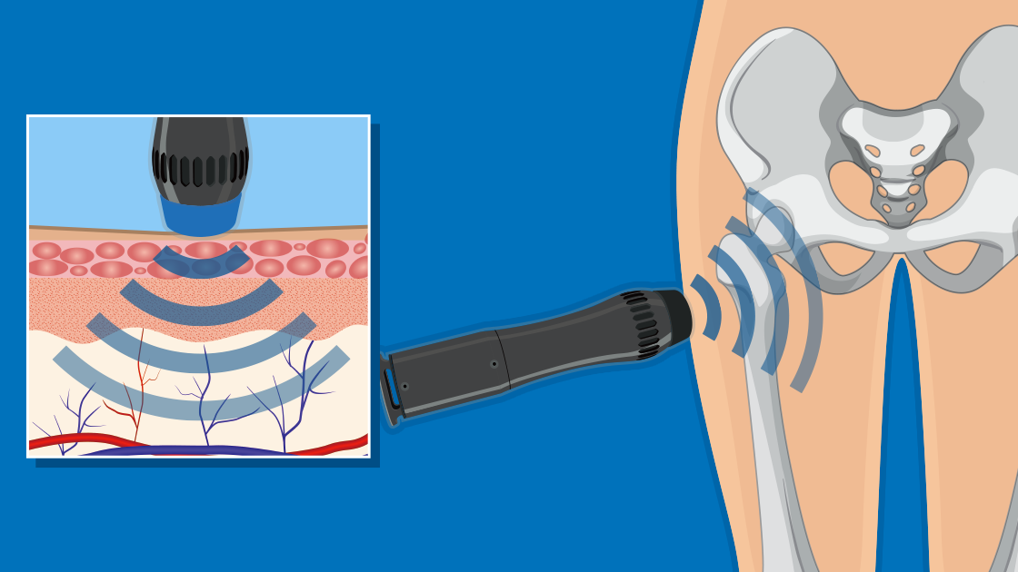 Shockwave Therapy for Outer Hip Pain: A Modern Solution to GTPS ...