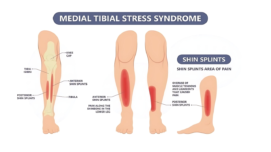 Running on Empty? Shockwave Therapy Can Fix Your Shin Splints ...
