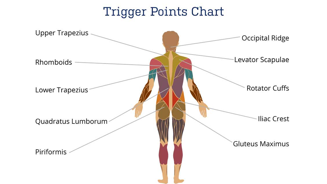 Trigger Point Development Muscle Knots and Trigger Points? Shockwaves Hit the Spot ...